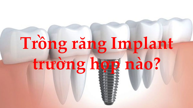 Trồng răng Implant cho trường hợp nào