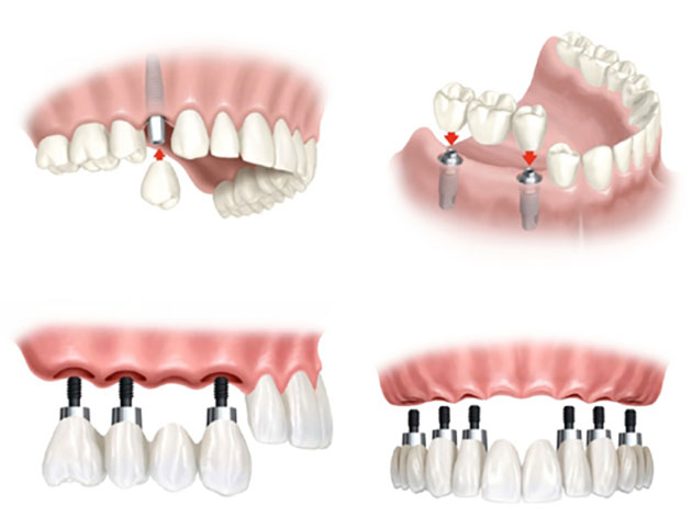 Trồng răng implant khi mất nhiều răng liên tiếp