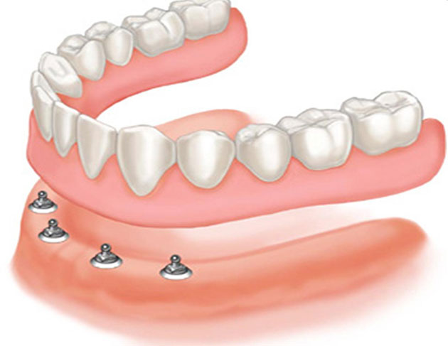Trồng răng implant toàn hàm