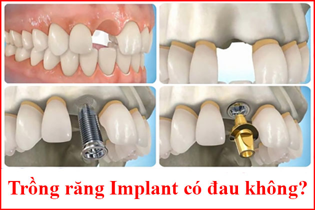 Trồng răng Implant có đau không?