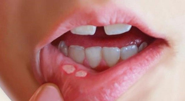 Bệnh nhiệt miệng