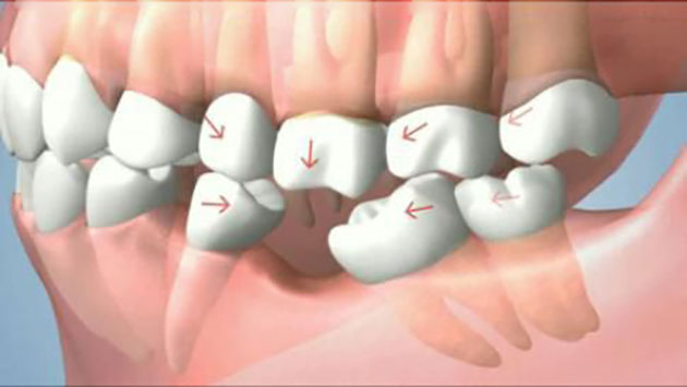 Hậu quả của mất răng