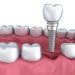 Implant giải pháp tốt nhất cho mất răng