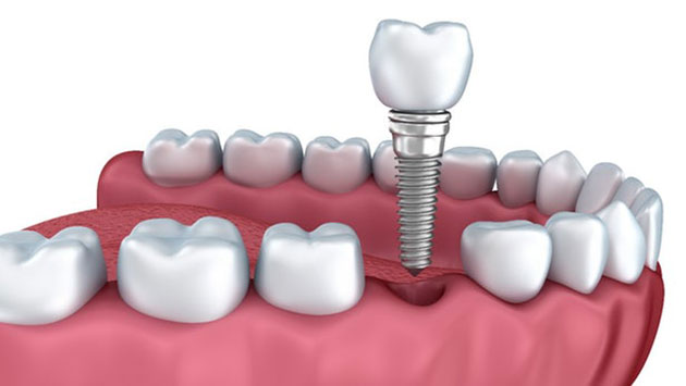 Implant giải pháp tốt nhất cho mất răng