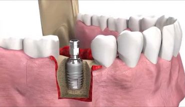 Kỹ thuật trồng răng implant