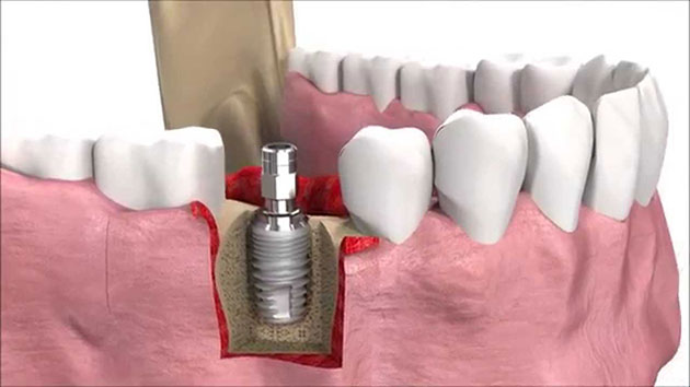 Kỹ thuật trồng răng implant