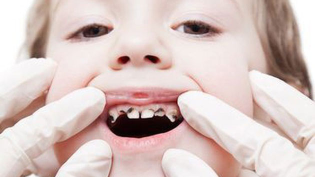 Sâu răng ở trẻ