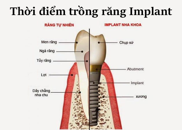Thời điểm trồng răng Implant
