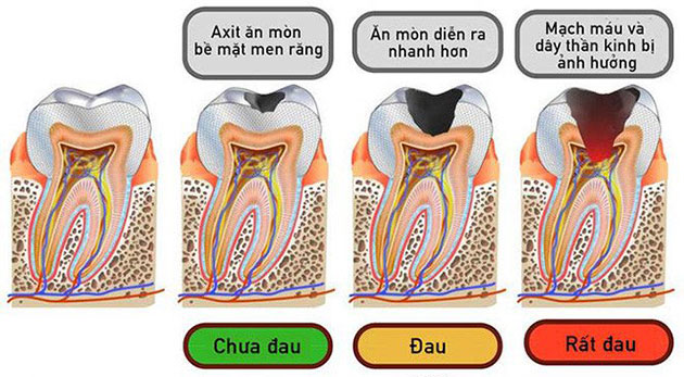 Quá trình hình thành sâu răng - Nhakhoadalat.vn