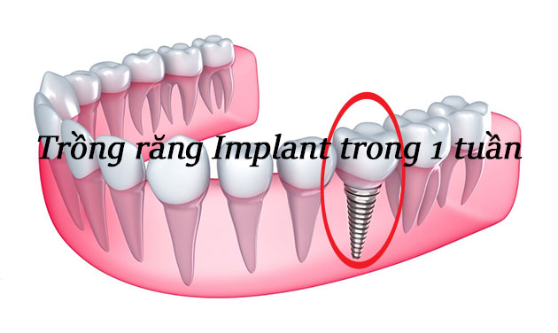 Trồng răng implant trong 1 tuần