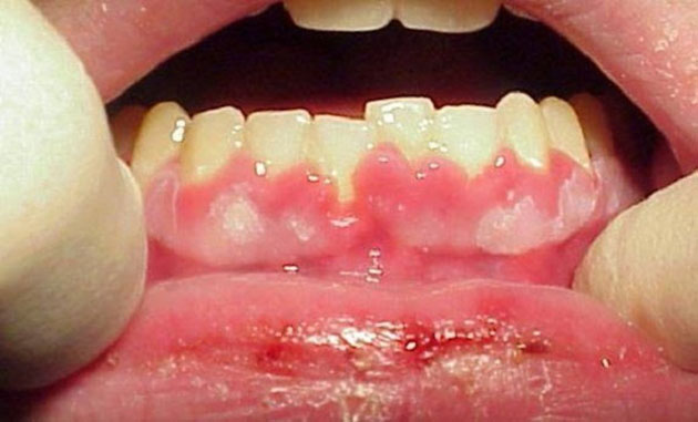 Viêm nướu trẻ em