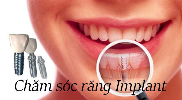 Chăm sóc răng implant
