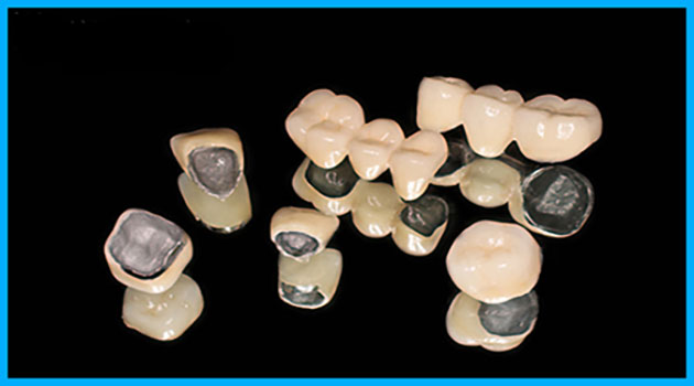 Mão răng - Cầu răng sứ kim loại