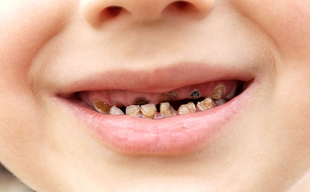 Sâu răng viêm nướu ở trẻ em