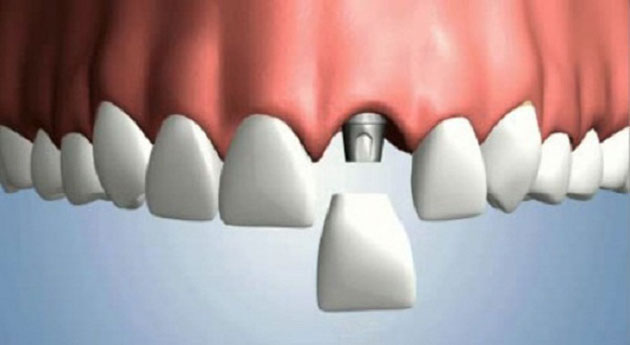 Trồng răng implant cho răng cửa